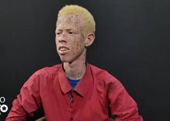 Albinos living with stigma and poverty in Somalia